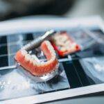 Quem pode fazer implantes dentários? Descubra se esse tratamento é para você