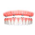 Protocolo sobre Implantes: A Solução definitiva para quem usa dentadura