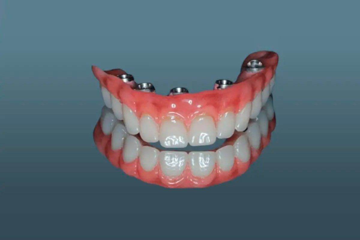 5 Vantagens do protocolo sobre implantes que vão mudar seu sorriso