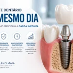 Implante Dentário no Mesmo Dia: Quem Pode Fazer Carga Imediata?
