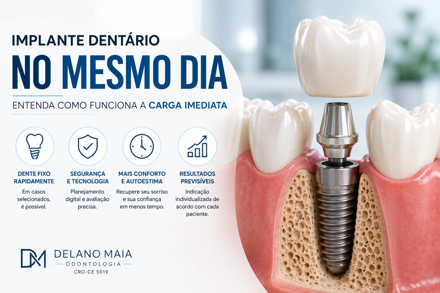 Implante Dentário no Mesmo Dia: Quem Pode Fazer Carga Imediata?