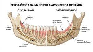 Comparação da mandíbula com osso saudável e osso reabsorvido após perda dentária.