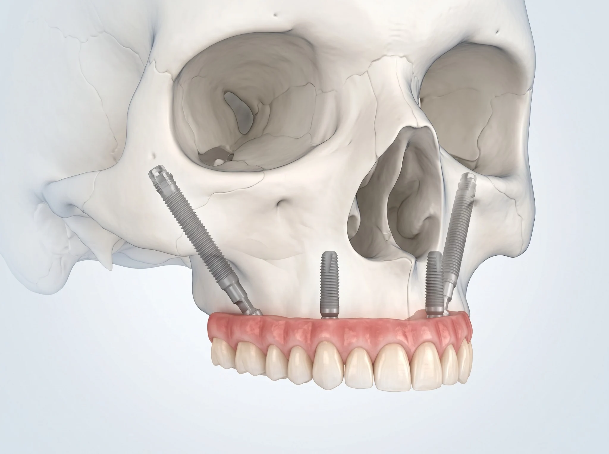 Ilustração 3D de prótese dentária fixa superior próxima a implantes convencionais e implantes longos na região zigomática.