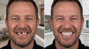 Comparativo de antes e depois de reabilitação oral com prótese protocolo fixa sobre implantes em paciente masculino, exibindo a restauração completa do sorriso e estética dental natural.
